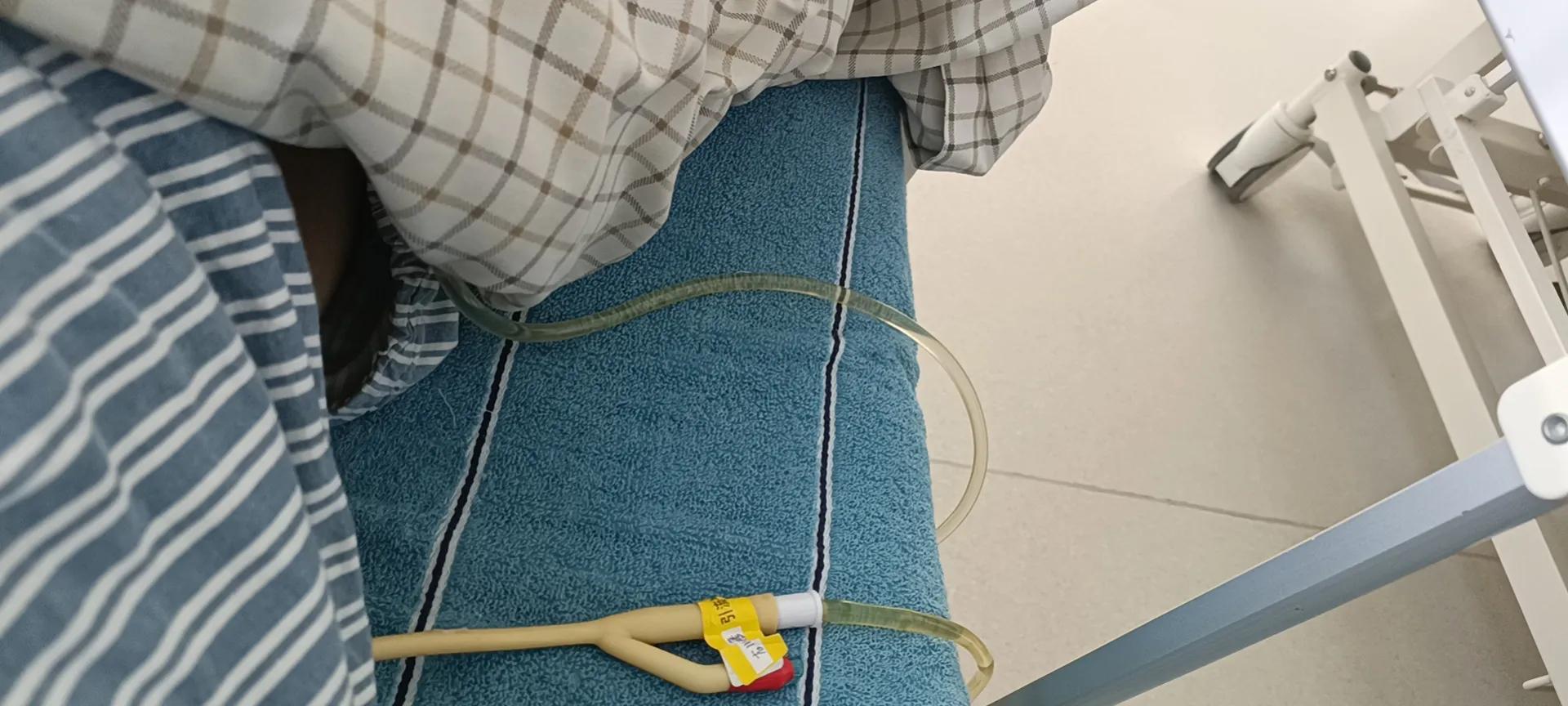 肾结石经皮肾镜两次手术间隔多久,两公分的肾结石需要动几次手术