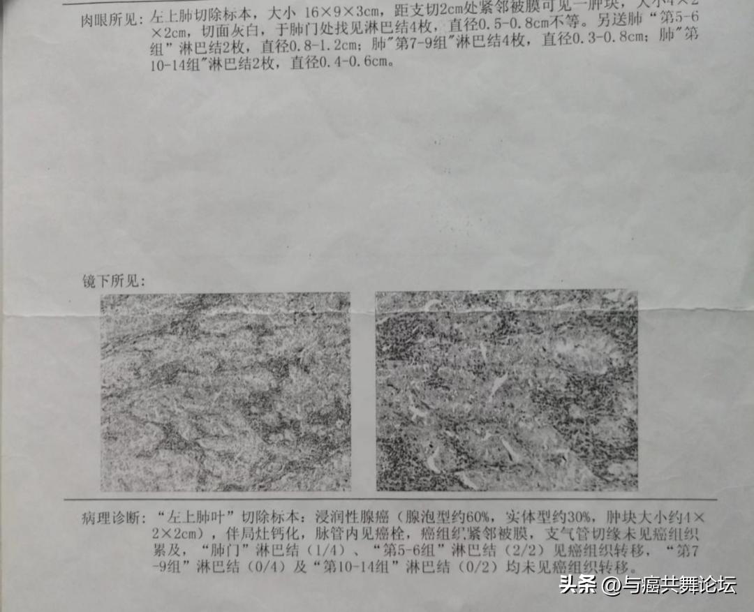 陪妻子抗癌多年视频,查出早期肺癌算是不幸中的幸运