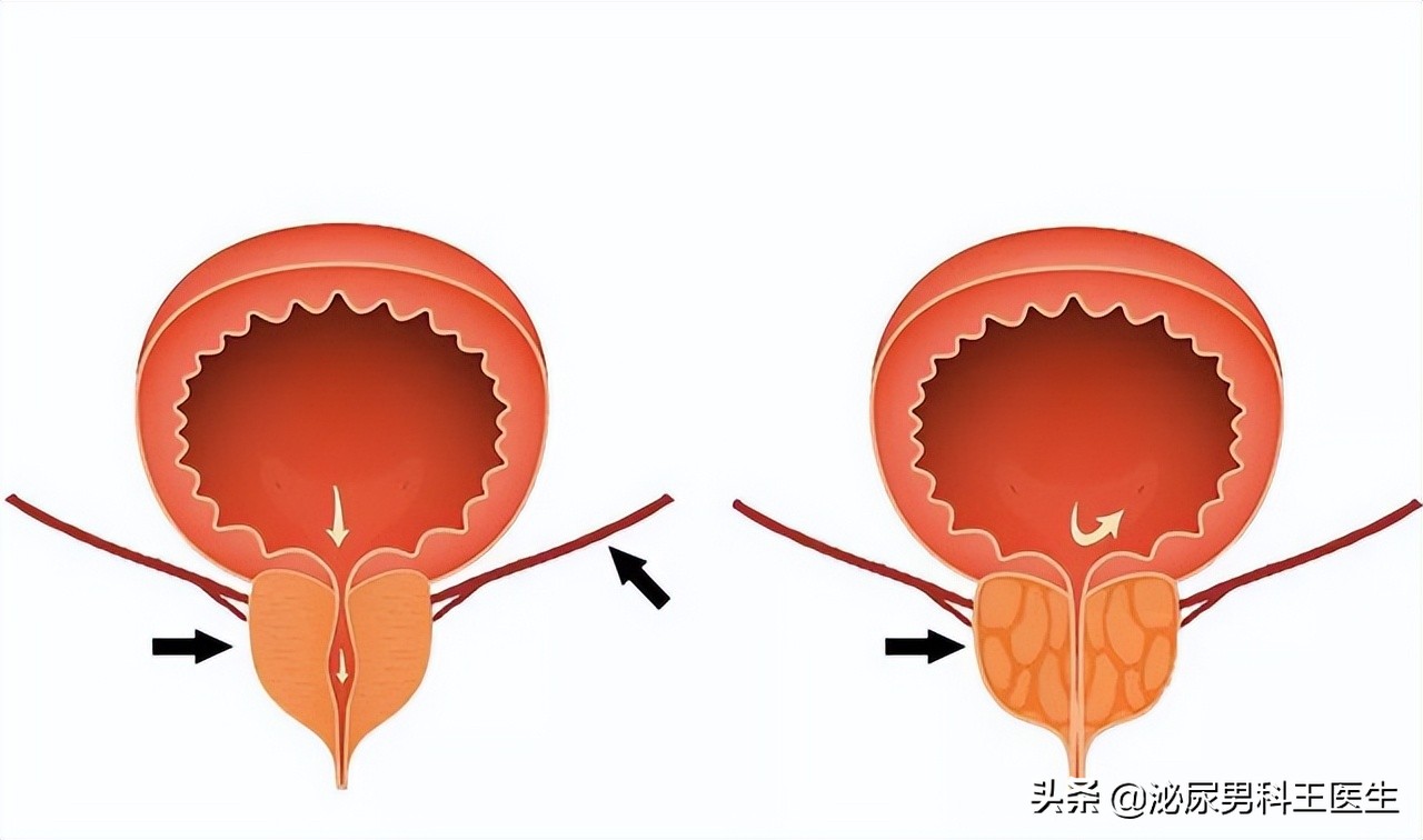 前列腺癌晚期骨转移症状有哪些,前列腺癌晚期患者临终前15个症状