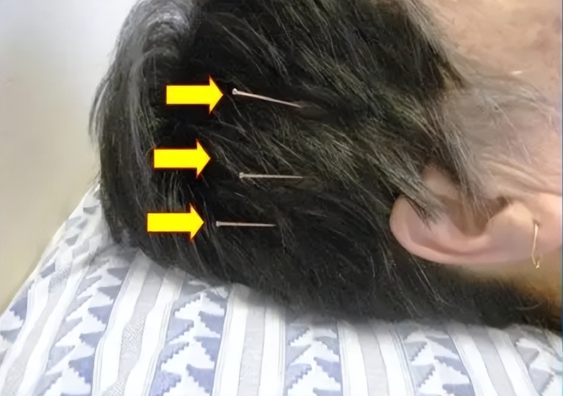 缺血性脑卒中中医治疗原则,急性缺血性脑卒中诊治指南最新版