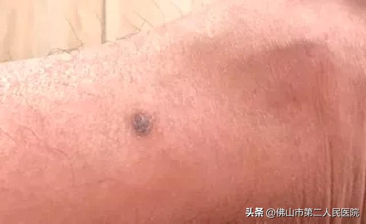 年轻歌手得黑色素瘤去世,歌手黑痣和黑色素瘤的区别