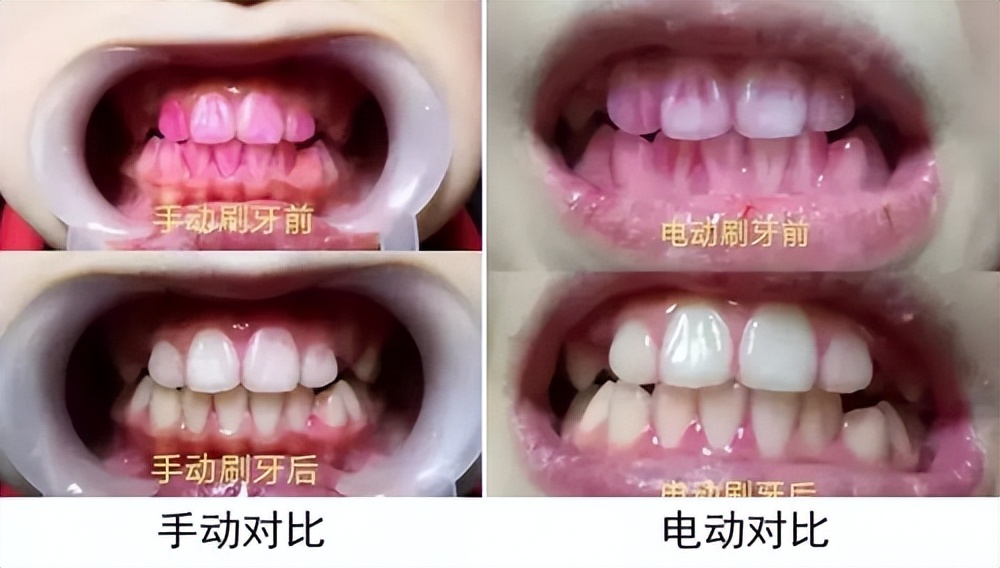 矫正牙齿期间可以用电动牙刷吗,电动牙刷加冲牙器会对牙齿损害吗