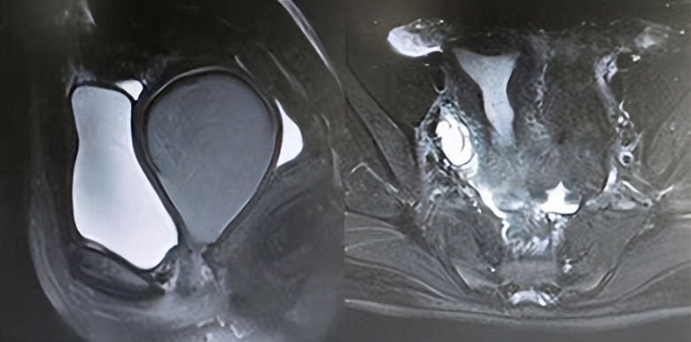 一个女性没有子宫会怎样,一个女性没有子宫会怎么样