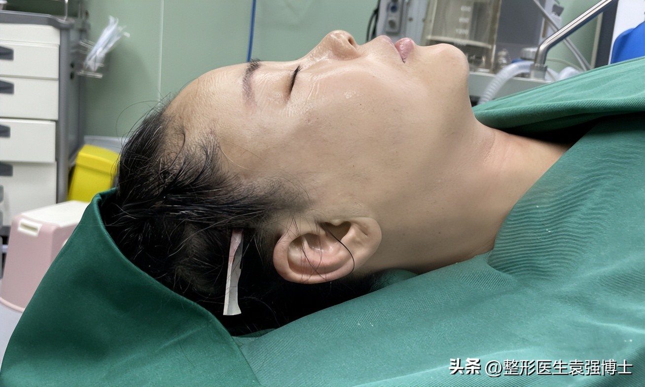 大拉皮前后效果,拉皮前后效果自然吗