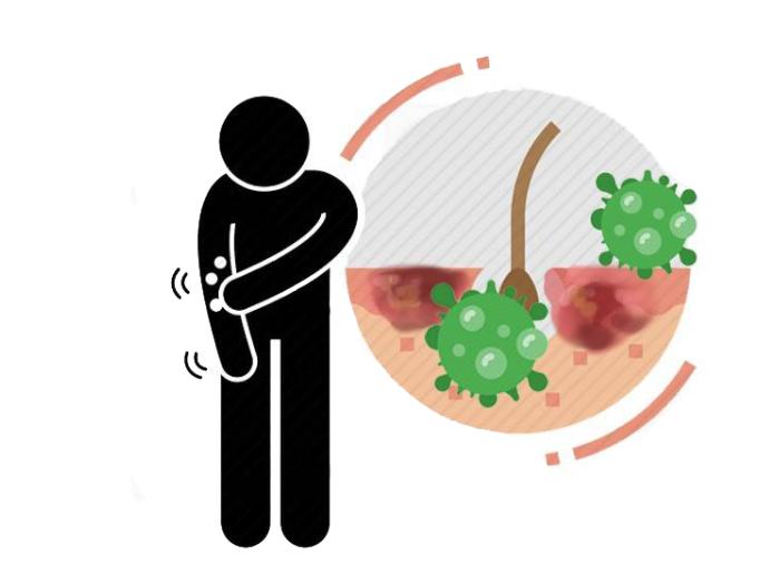 缠腰龙病如何发生的,缠腰龙是怎么样引起的