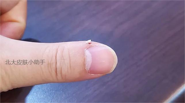 手贱，爱抠手皮、撕手皮、咬手指！指甲旁的死皮可以直接撕掉吗？