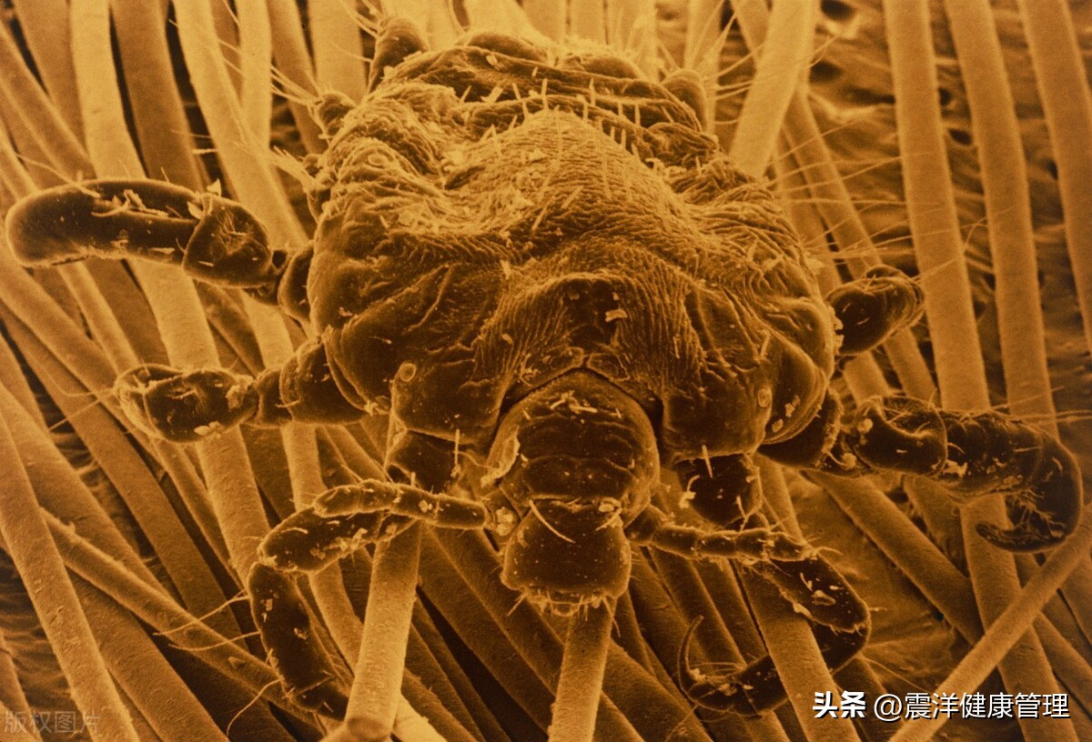 男子腹部痒，医生用镊子夹出16只阴虱！原来阴虱的传播途径有4个