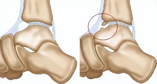 脚踝疼痛别大意，警惕这个疾病找上门！