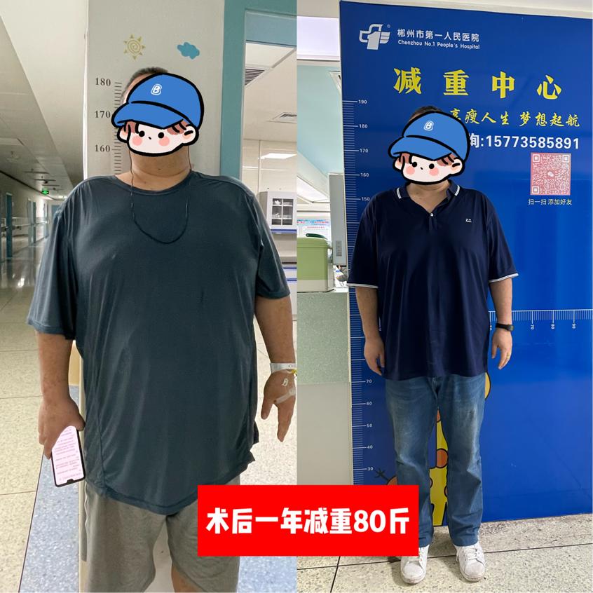 【5.11中国肥胖日】“减重手术”让你不再负“重”前行