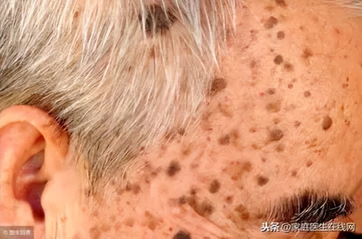 老年斑和色素沉着怎么治,老年人色素沉着怎么去除