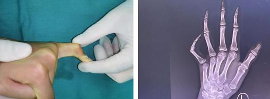 有一个手指伸不直,第一节手指伸不直