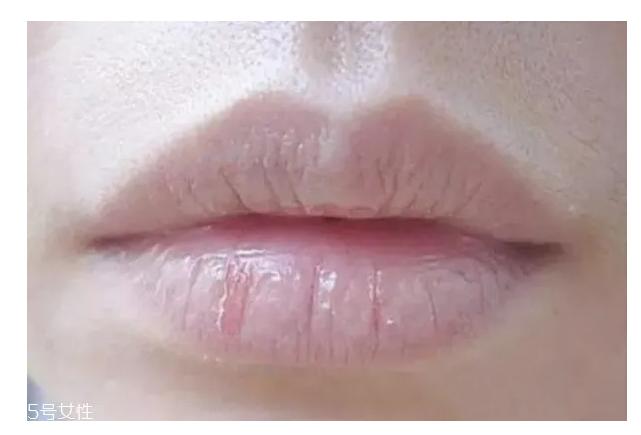 嘴唇干燥起皮中医怎么治疗最有效,冬天嘴唇干燥起皮嘴角发炎怎么办