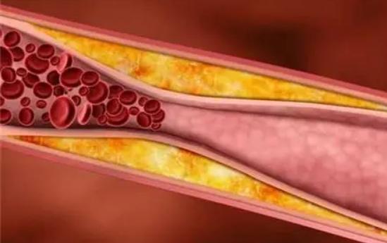 血液粘稠手麻该多注意什么,手麻平时应注意些什么