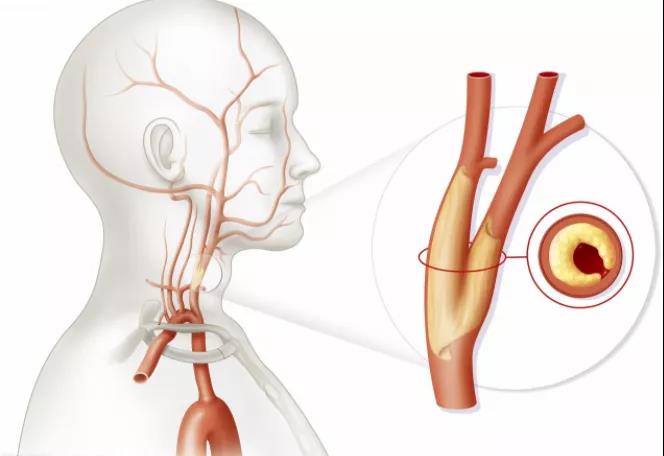 脑血管搭桥后癫痫,脑血管病后癫痫