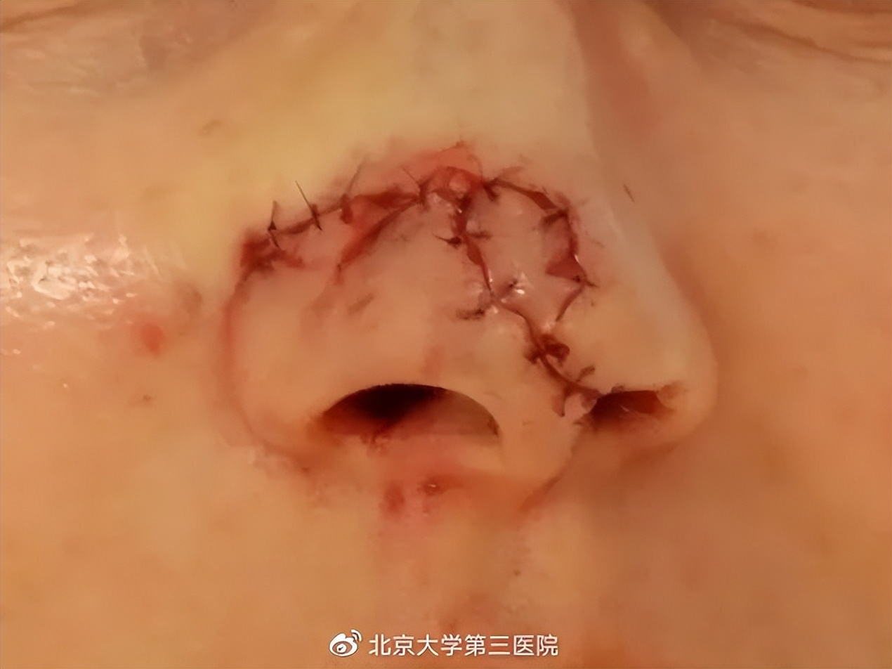 意外留疤怎么安慰,眉尾意外受伤留疤好不好