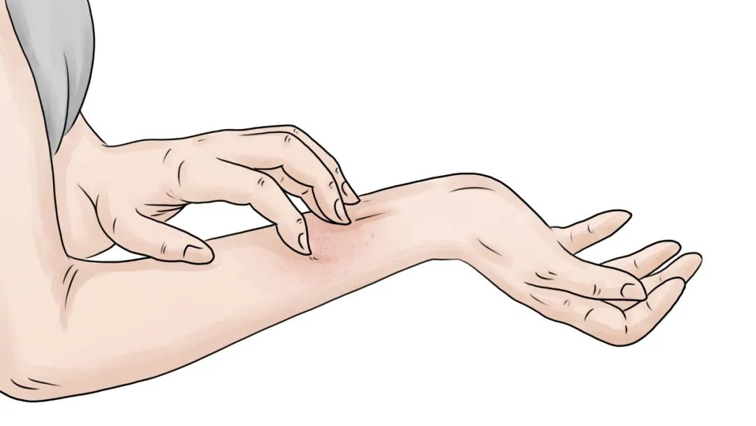 盘点！药疹的发病机制和6种常见药疹类型，看完你会有所收获