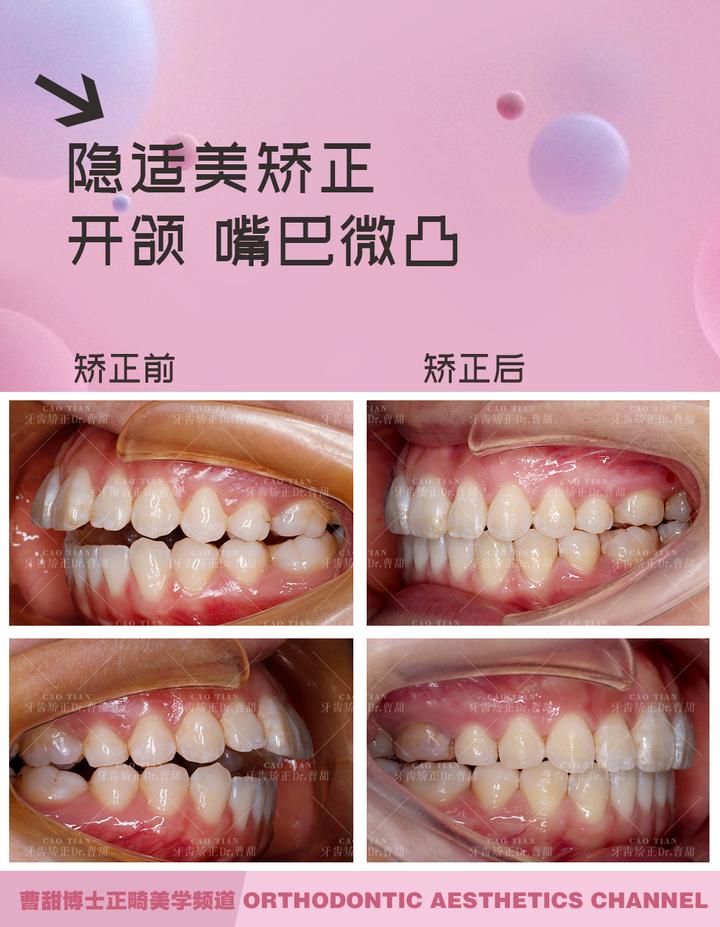 上下牙无法咬合是怎么回事,30岁牙齿咬合开颌还有必要矫正吗