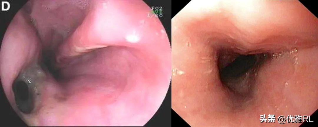 吃了一口辣椒得了重病,吃了一顿辣椒肚子烧的不行
