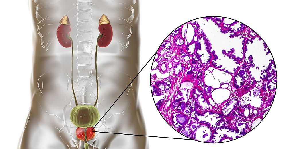 排尿费劲,滴滴答答怎么办?医生为您专业解答
