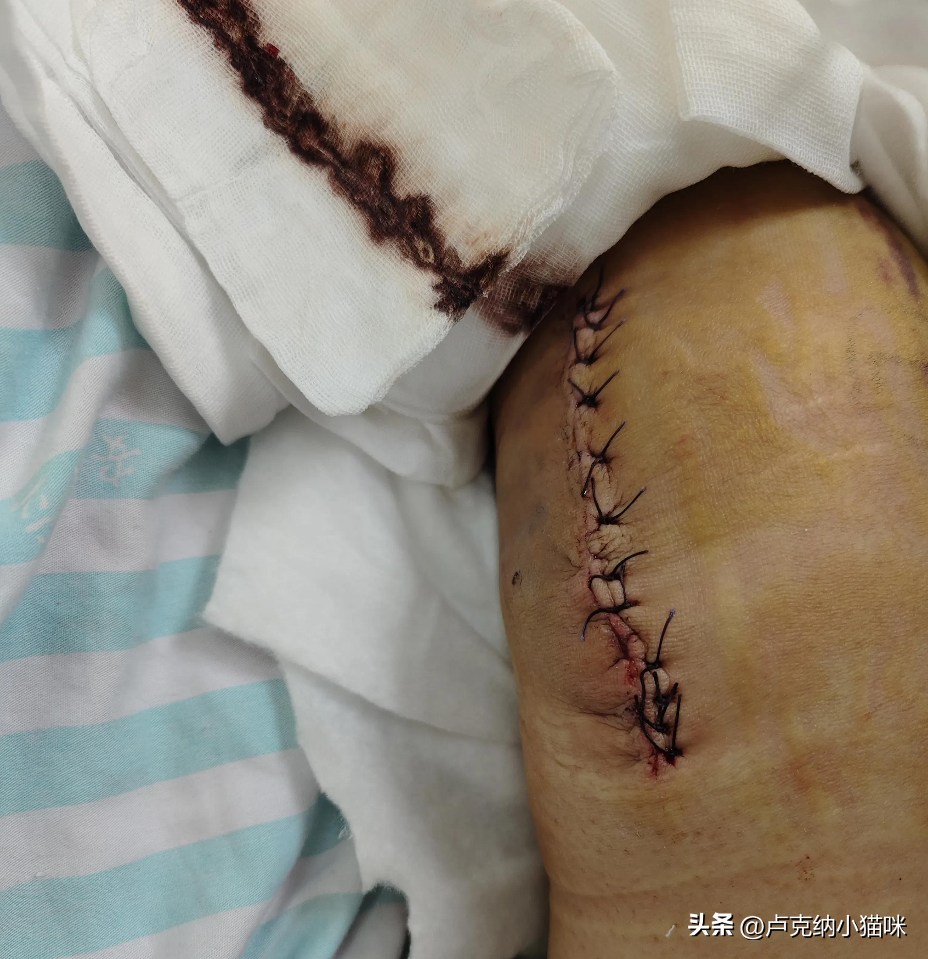 髌骨骨折术后康复训练得痛多久,髌骨骨折术后第一次做康复