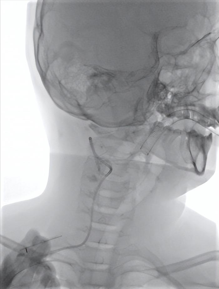 2岁颈部水囊状淋巴管瘤,颈部淋巴管瘤微创介入手术方法