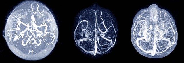 中医专业讲解常见病头痛,头痛疑难杂症案例