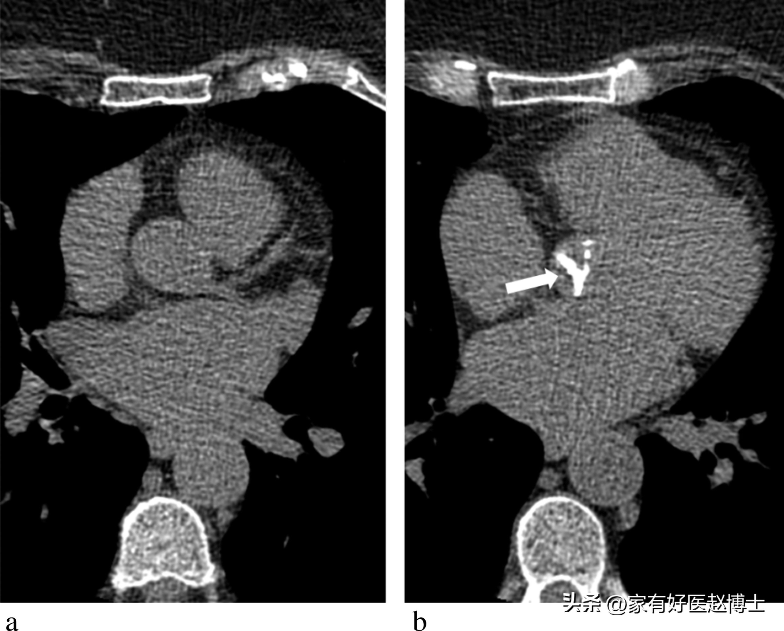 体检提示心血管局部钙化,体检发现冠脉见钙化影是什么意思