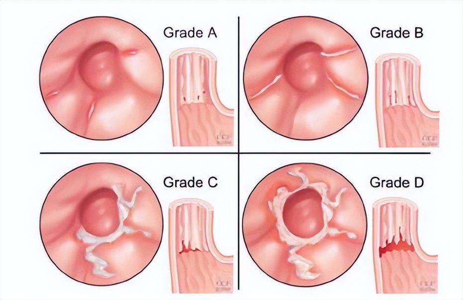 一院消化内科,胃食管反流病国内哪家医院最权威