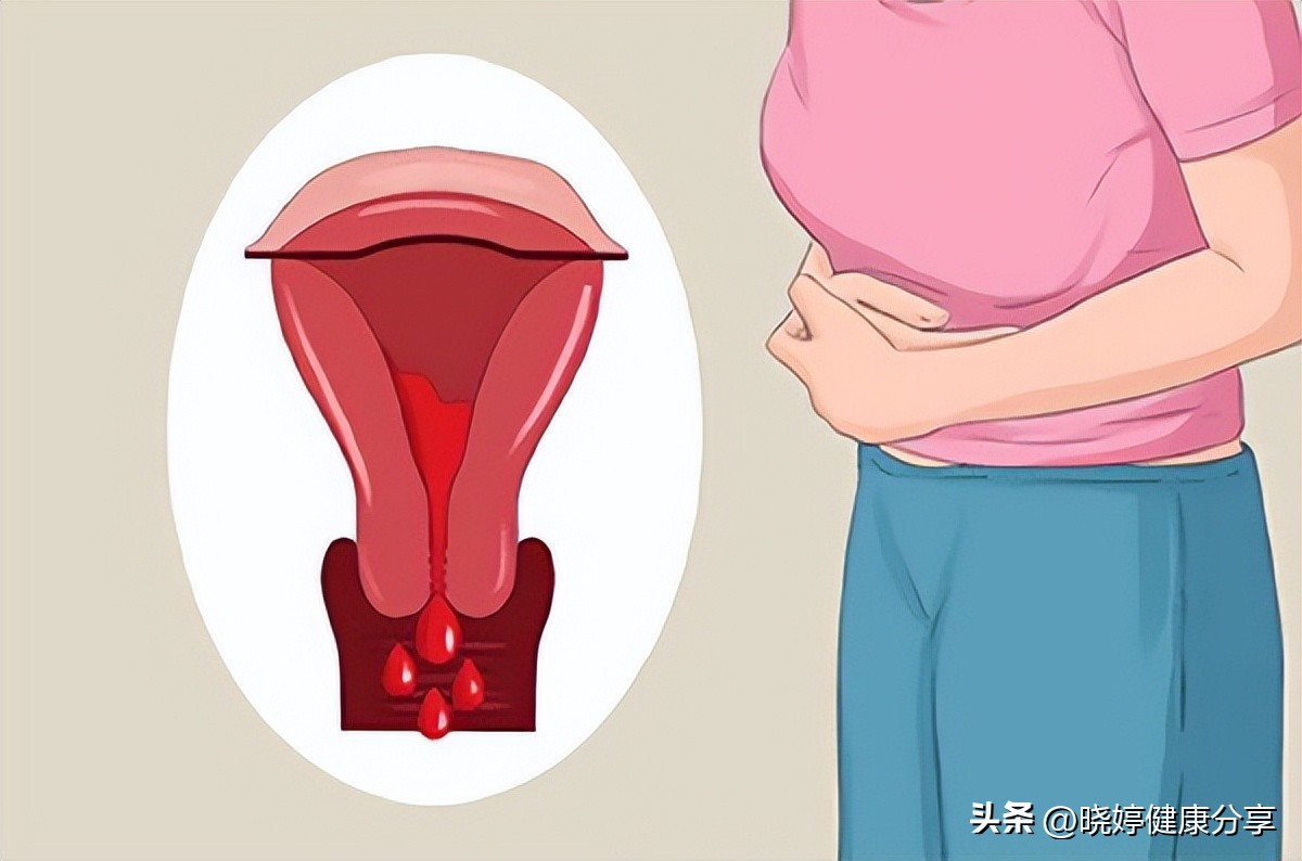 更年期月经过多怎么办,月经过多有血块怎么办