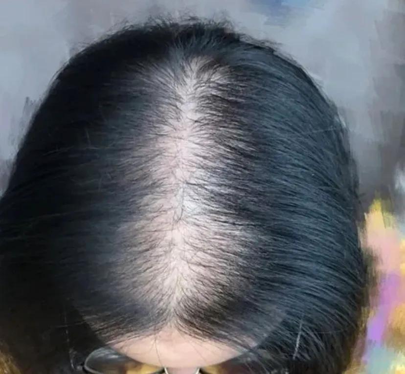 一个月内如何快速生发不变秃头,已经秃的地方怎么快速生发