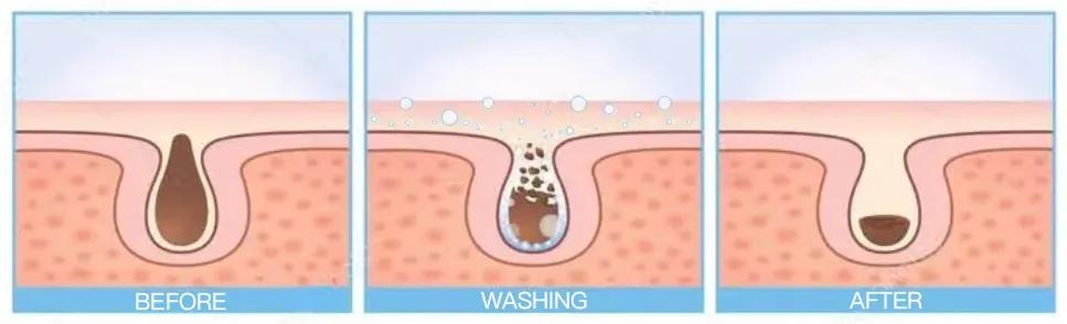 超微小气泡治疗黑头,超微小气泡清洁黑头仪