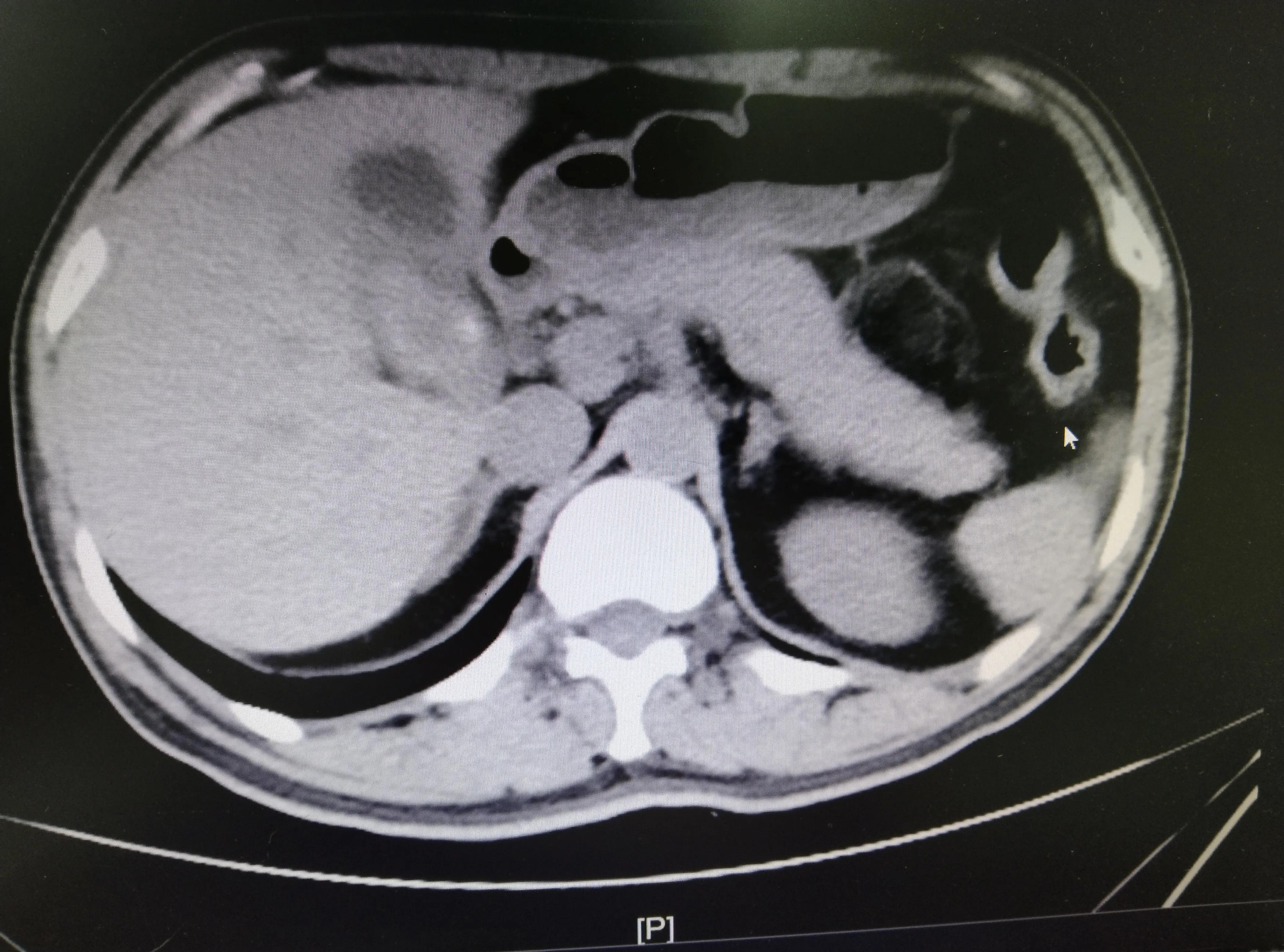 胆囊炎胆囊结石怎么办,胆囊结石最佳处理方法