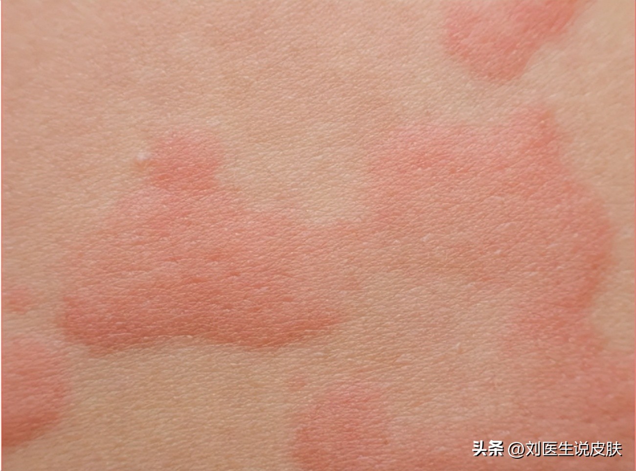 秋天皮肤干燥痒用什么润肤,夏天皮肤干痒用什么护肤