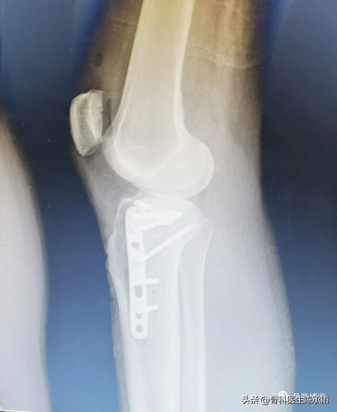 膝关节胫骨平台骨折,最近胫骨平台骨折视频