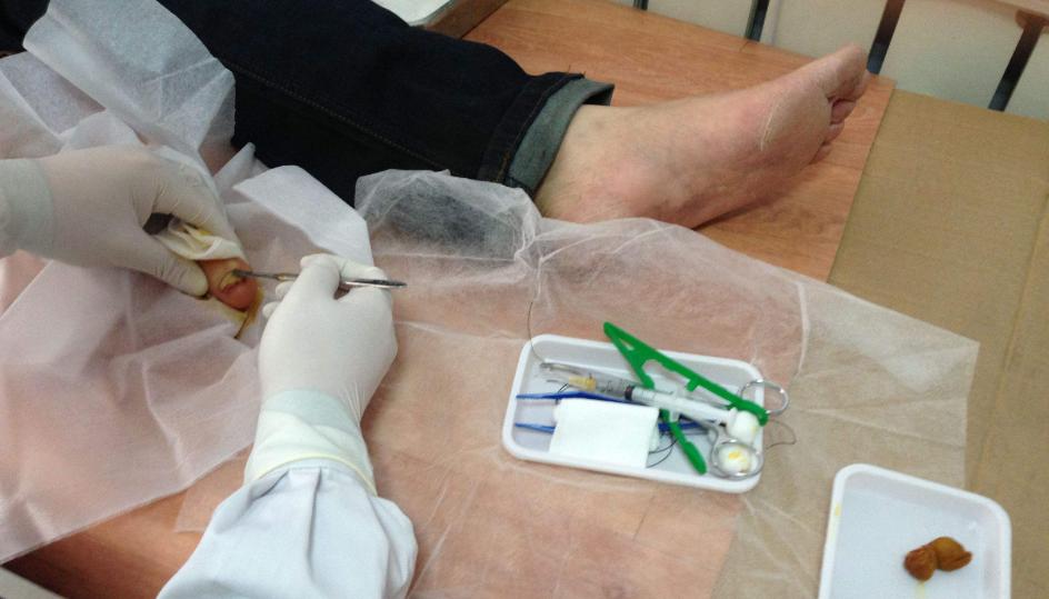 得了甲沟炎一定要拔指甲就能好吗,甲沟炎指甲陷肉里拔不出来怎么办