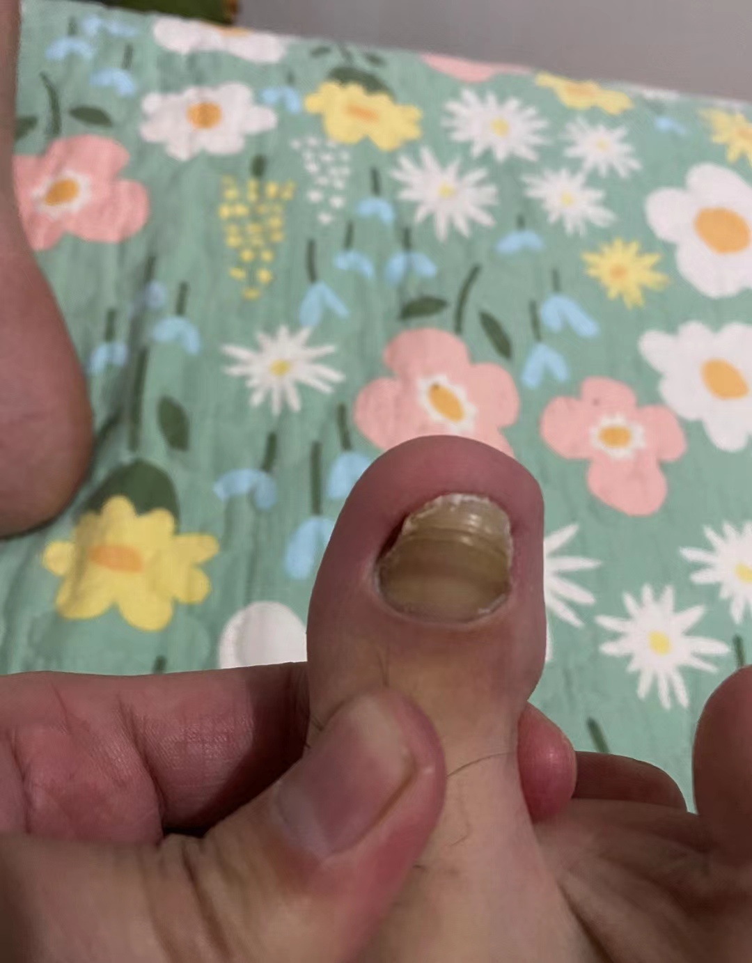 只需2步，轻松去除灰指甲！手把手教会你，每天才花几毛钱！