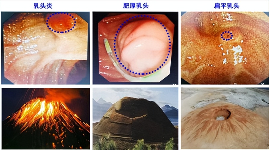 胆囊切除后出现腹胀怎么消除,胆囊切除后肝功能指数过高