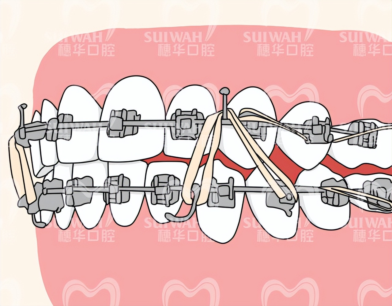 疫情期间牙矫正怎么办,疫情期间牙套复诊不了