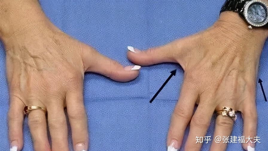 肩关节痛应与什么病鉴别,肩痛有可能是患上哪些病