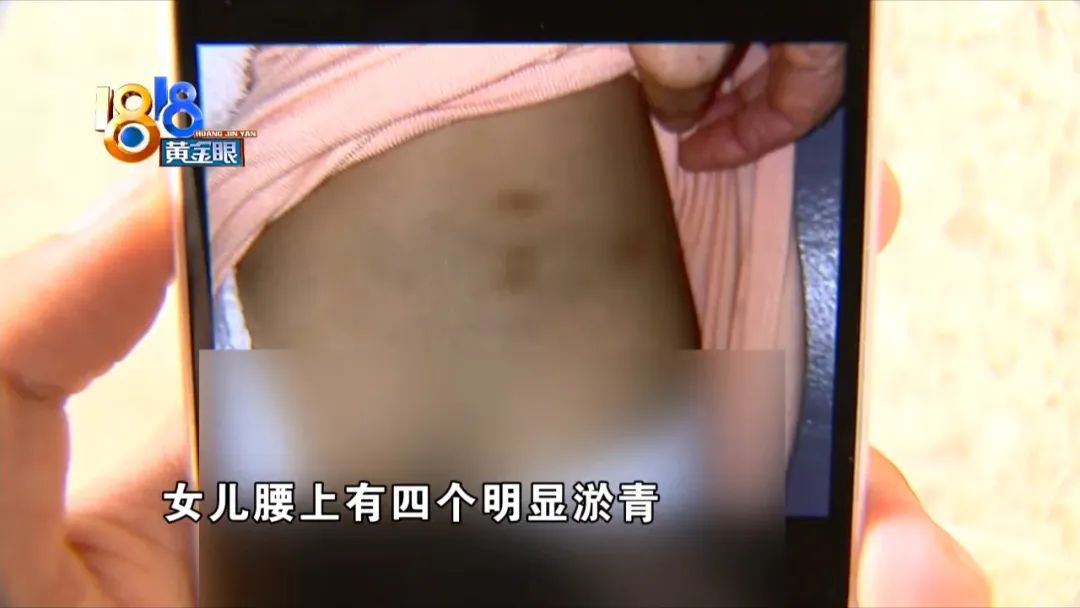 母亲发现女儿的淤青,发现女儿小腿有几块淤青