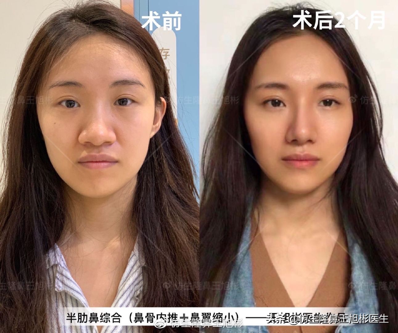 常见鼻部整形美容项目,整形鼻和自然鼻