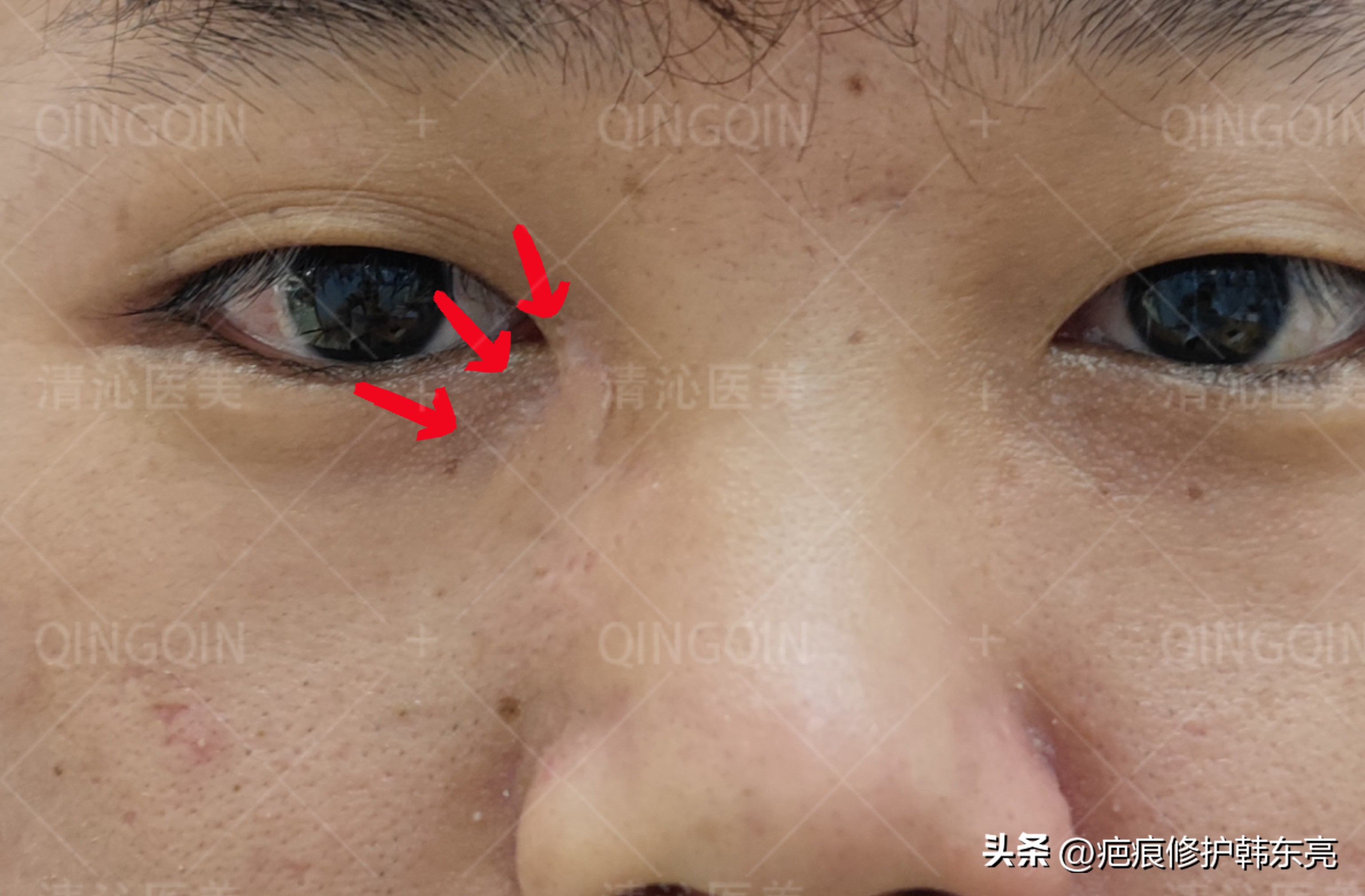 疤痕修复一次需要多少钱,上海九医院疤痕修复价目表2021