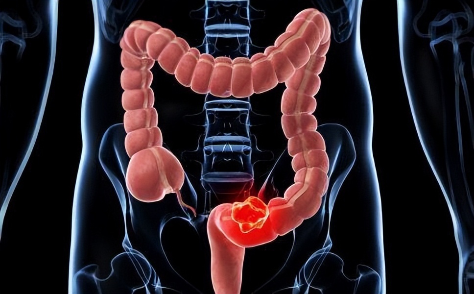 肠镜能区分痔疮和肠癌吗,肠癌血与痔疮血怎么区分