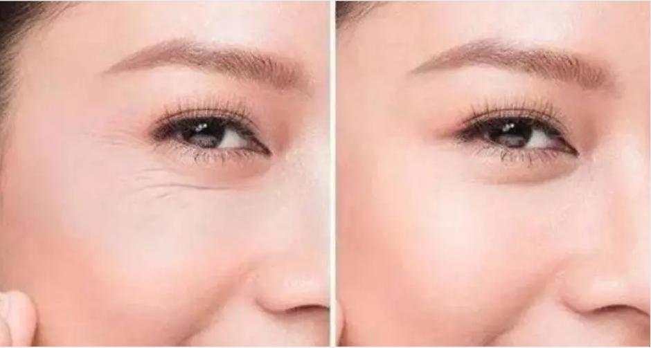 什么是鱼尾纹,有了鱼尾纹该如何补救