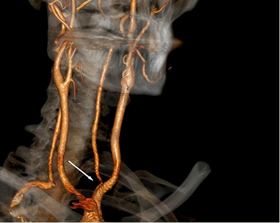 冠心病诊断预测模型,建模预测冠心病