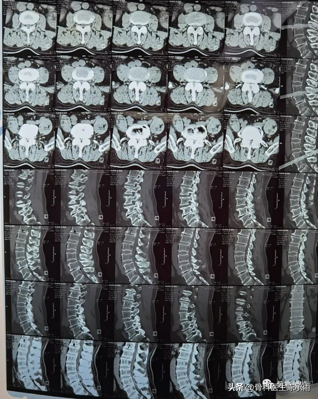 腰椎滑脱椎管狭窄手术后遗症,腰椎间盘突出椎管狭窄的手术