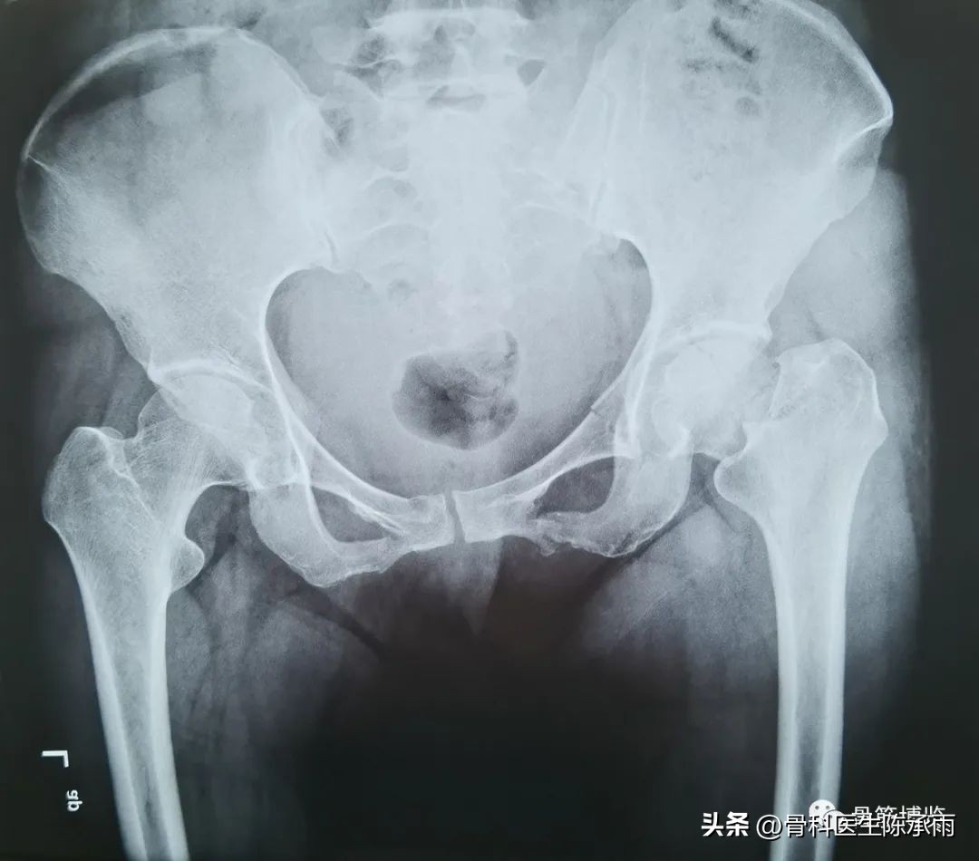 股骨颈闭合复位内固定术后护理,股骨颈骨折闭合复位的技巧