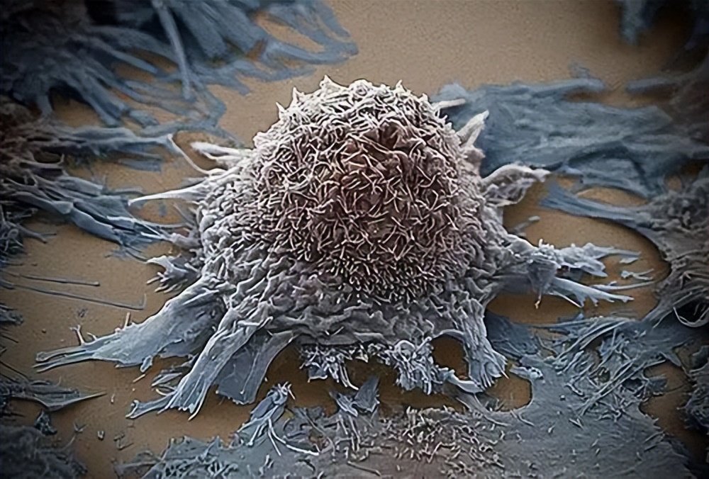 脚后跟长鸡眼严重性,脚后跟有个三四年的鸡眼