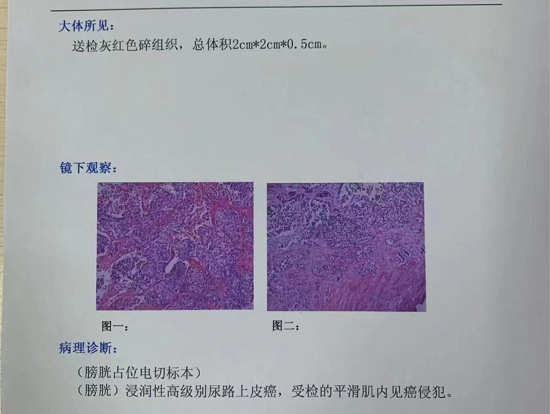 警惕血尿,女性突然无痛血尿一定是膀胱癌吗
