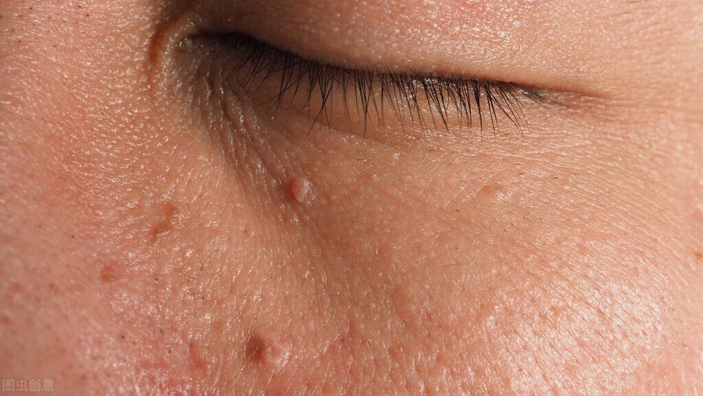 瘊子和刺瘊的区别,瘊子是很常见的疾病吗